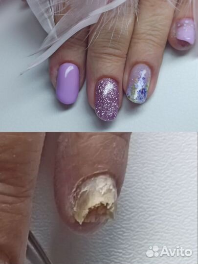 Подолог Коррекция вросшего ногтя