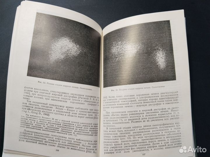 Хронические гепатиты и циррозы печени, Логинов