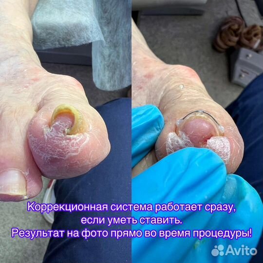 Подолог (вросший ноготь, мозоли, трещины)