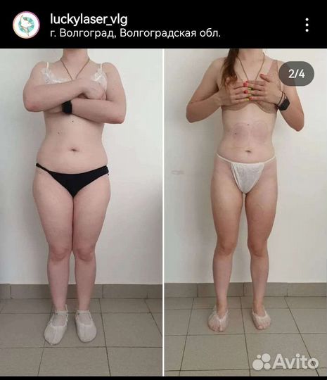 Коррекция фигуры, аппаратные процедуры