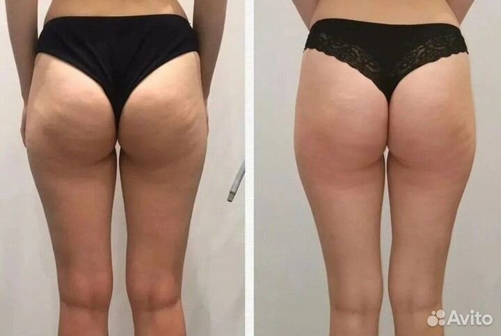 Турбо похудение лица и тела