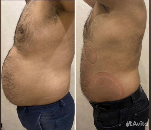 Криолиполиз