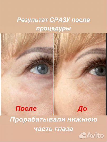 Smas лифтинг на лицо