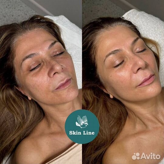 Микротоки / омолаживание