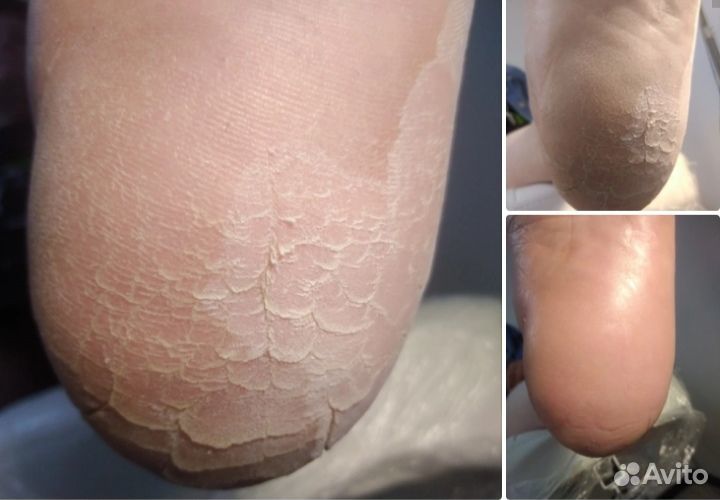 Маникюр, педикюр, удаление мозолей