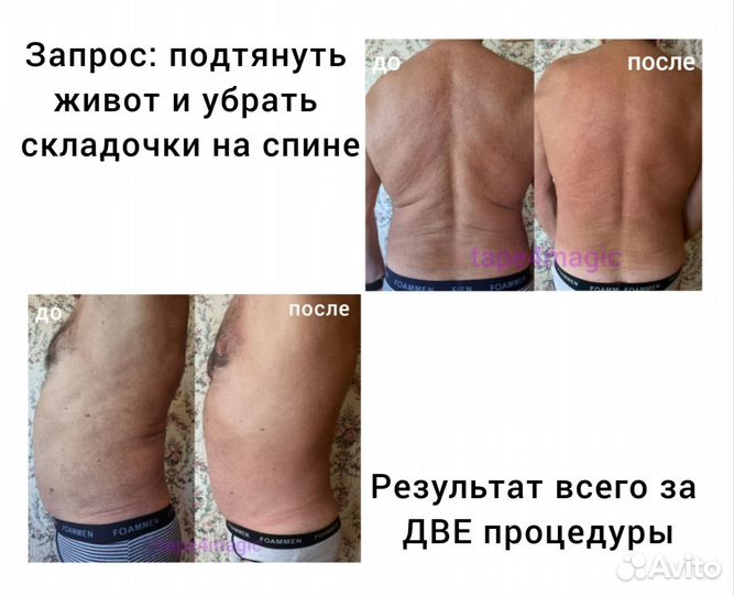 Эстетическое тейпирование. Коррекция фигуры