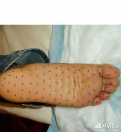 Устранение потливости. Гипергидроз