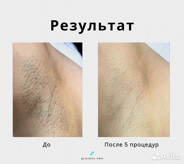 Аппарат для эпиляции Lumines’ Макс Ван 1200W