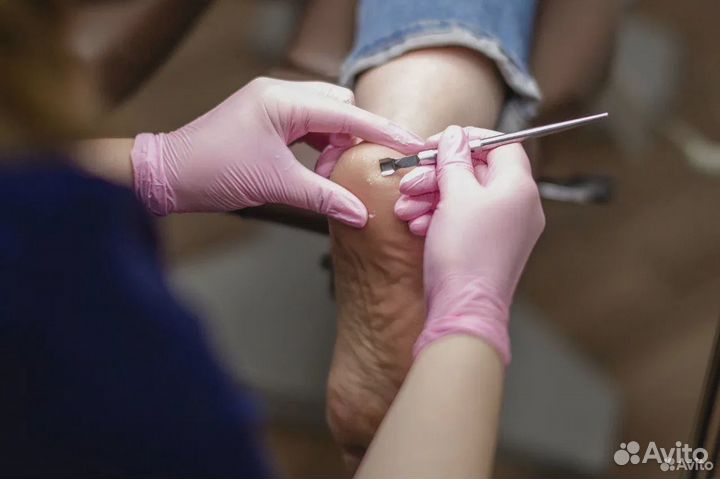 Удаление бородавок / мозолей на стопе / Подолог