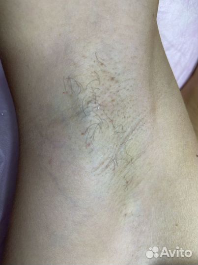 Электроэпиляция - удали навсегда волосы