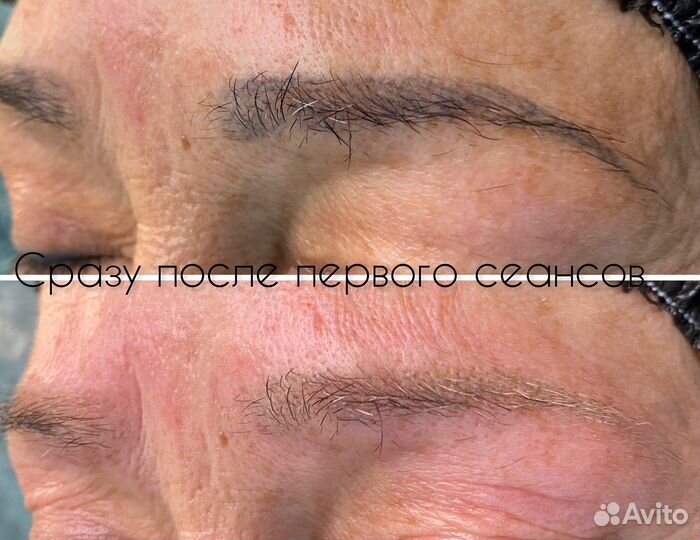 Лазерное удаление татуажа/тату. Карбоновый пилинг