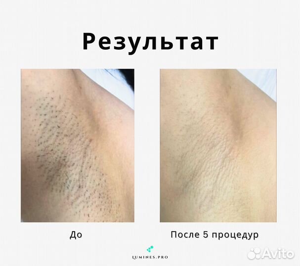 Аппарат для эпиляции люминес максван 1200