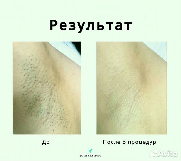 Диодный лазер для эпиляции люминес Макс-Ван 1200в