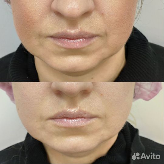 Смас лифтинг / smas лифтинг