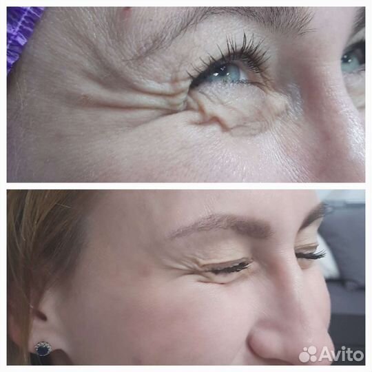 Ботокс требуются модели