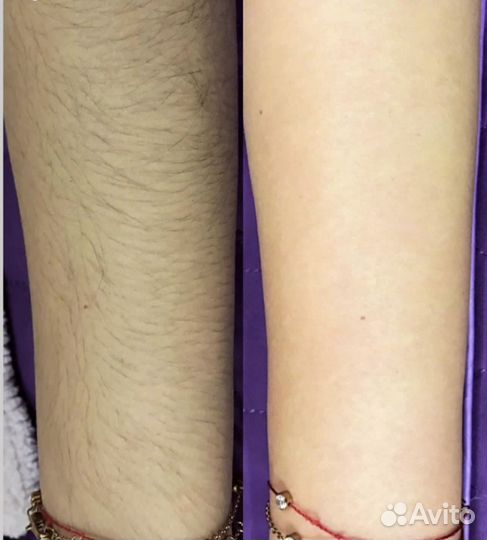 Шугаринг депиляция