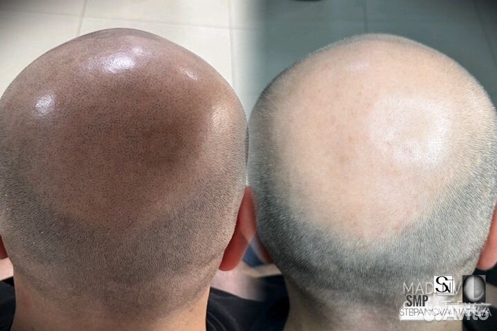 Трихопигментация SMP