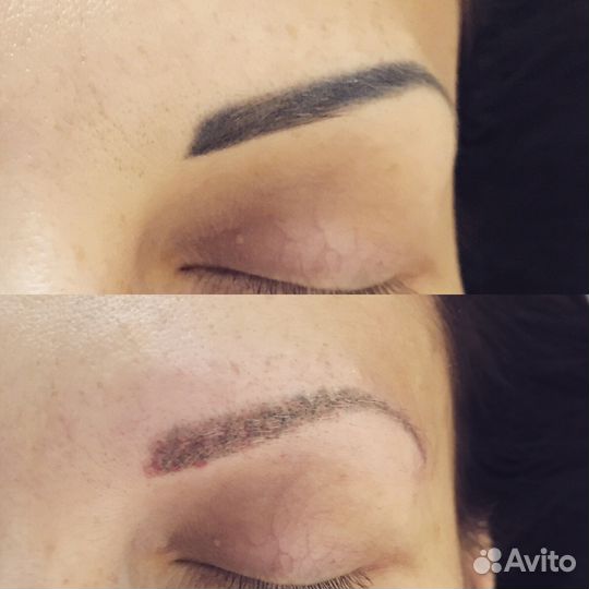 Удаления татуировок и татуажа