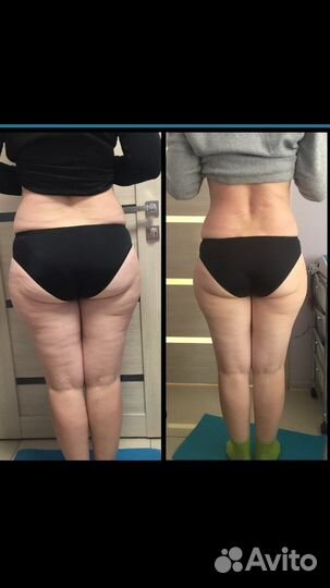 Антицеллюлитный массаж