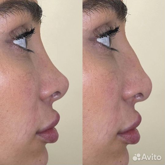 Уменьшение носика навсегда