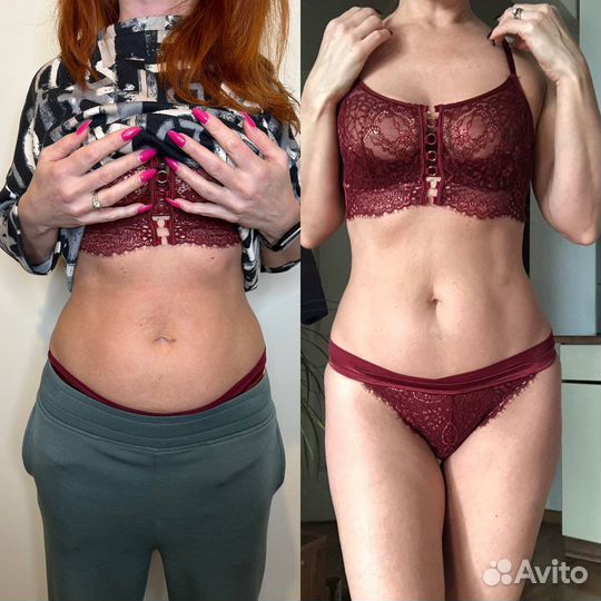 Похудение криолиполиз кавитация RF