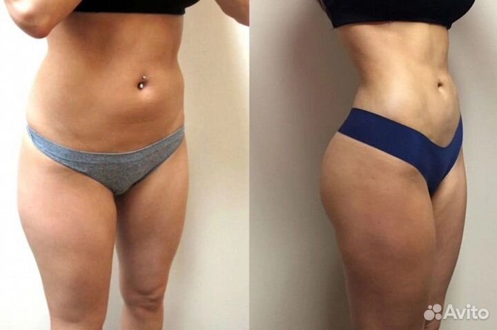 Антицеллюлитный массаж