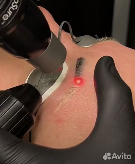 Лазерное удаление тату и перманента