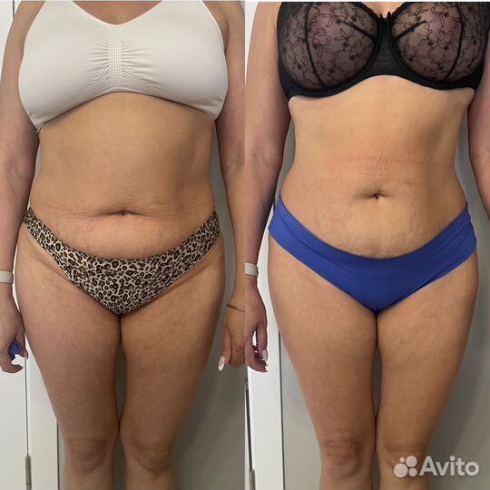 Жиросжигающий массаж, антицеллюлитный, классика