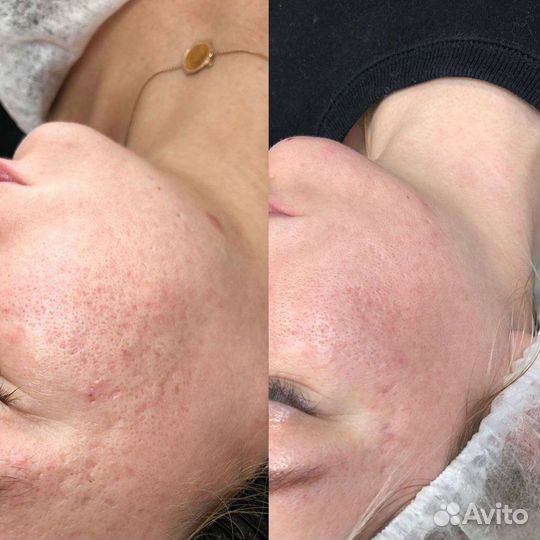 Комбинированная чистка лица