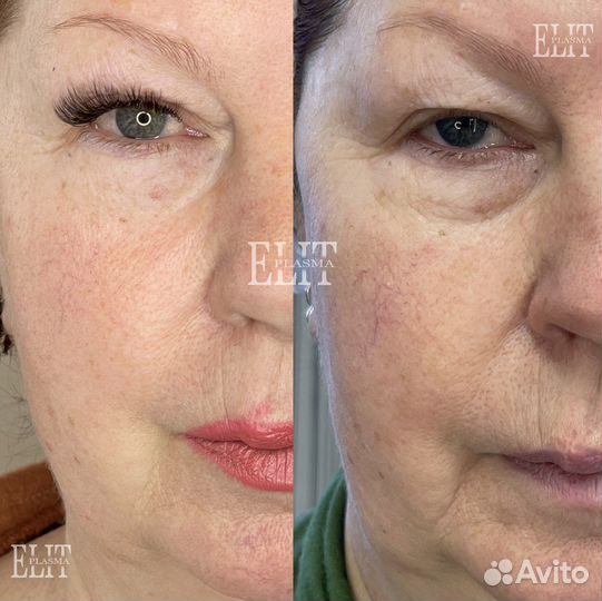 Омоложение холодной плазмой Ангарск