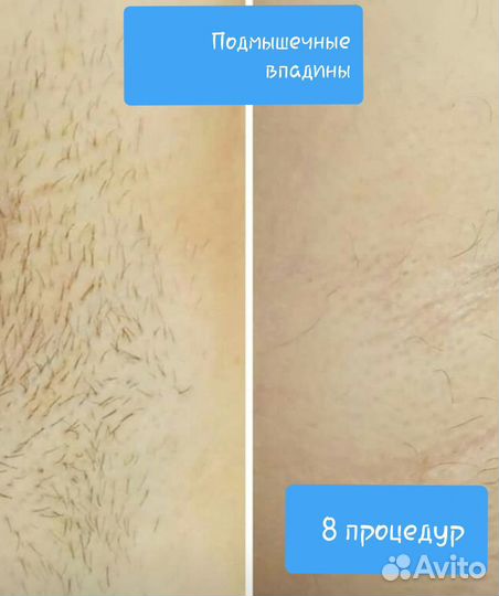 Электроэпиляция