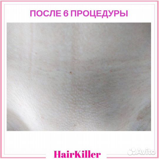 Лазерная эпиляция. Диодный лазер. Медобразование