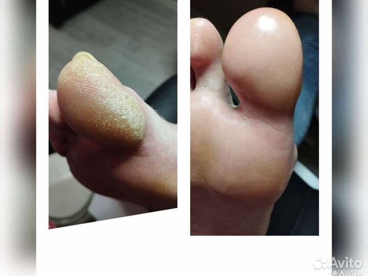 Педикюр, SMART педикюр, мужской,к пожилым выезд