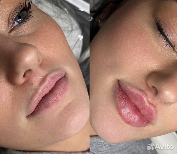 Увеличение губ, коррекция носа