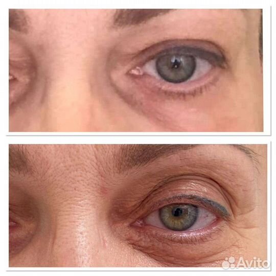 Комбинированная чистка лица