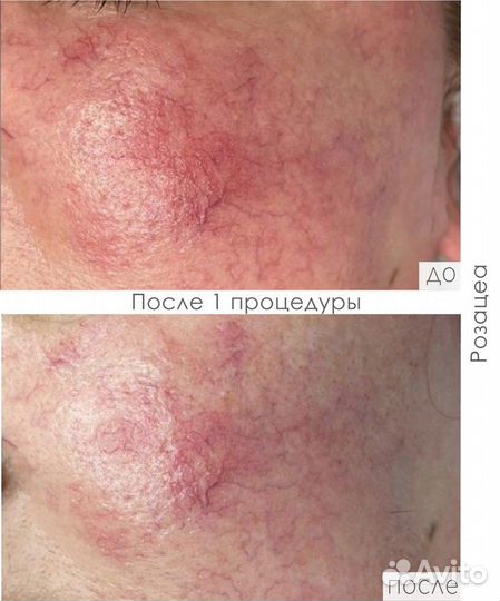 DermaQuest Пилинг с Азелаиновой кислотой