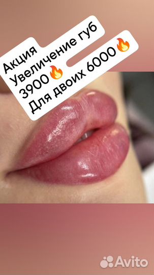 Увеличение губ