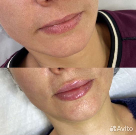 Увеличение губ