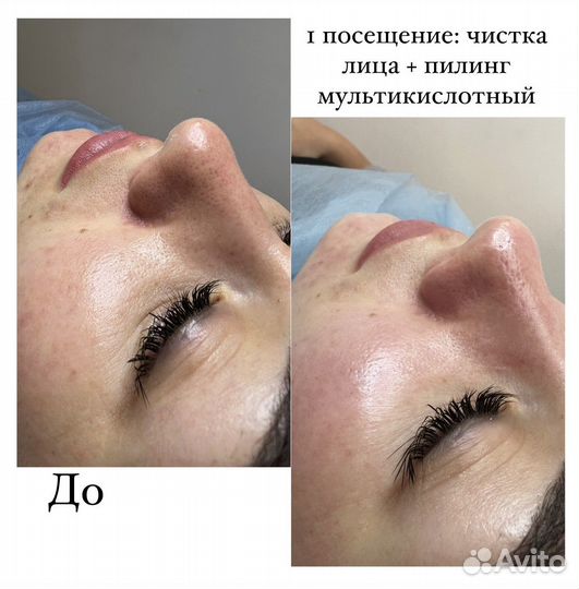Чистка лица + пилинг в подарок