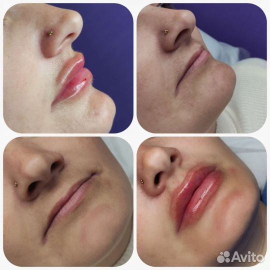 Увеличение губ