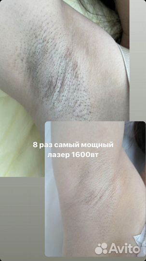 Лазерная эпиляция