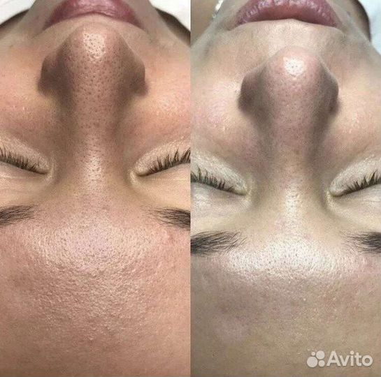 Комбинированная чистка лица