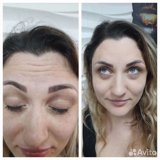 Ботокс требуются модели