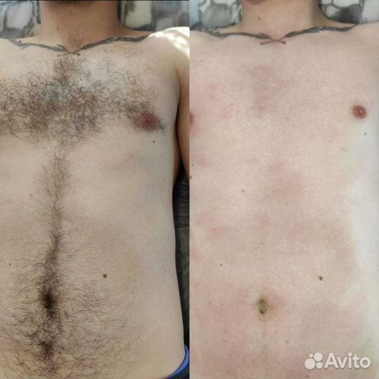 Шугаринг: руки выше локтя