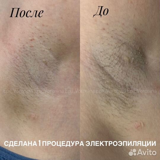 Электроэпиляция