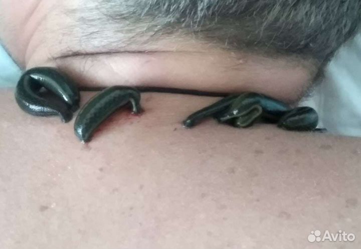 Купон гирудотерапии