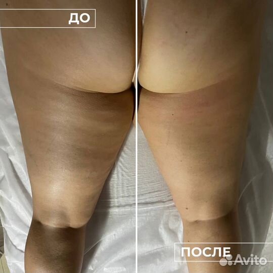 Эндосфера массаж, коррекция фигуры