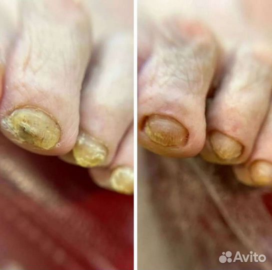 Подолог есть выезд, грибки вросшие ногти и др