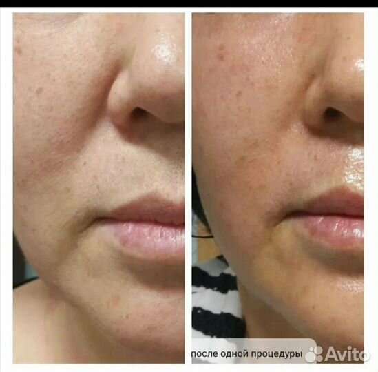 Микроигольчатый RF лифтинг