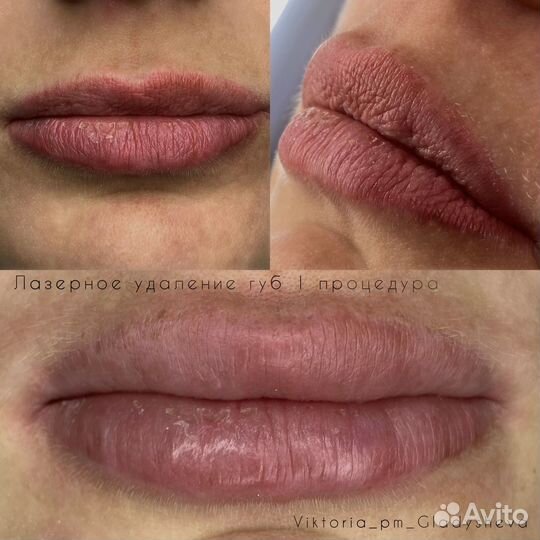 Удаление перманентного макияжа татуажа татуировок